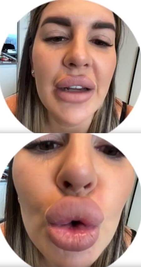 Почему быстро сдуваются губы. Почему быстро сдуваются губы. Почему быстро сдуваются губы. Почему быстро сдуваются губы. Отеки от гиалуроновой кислоты.