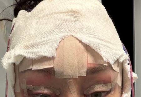 Первого марта 2026 года Алёна Ашмарина наконец представила публике свою внешность после перенесённой пластической операции.