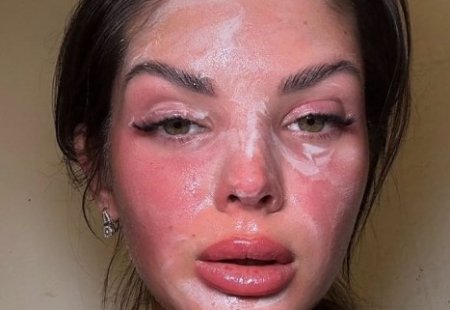 Двадцать первого апреля 2026 года Анна Самонина, получившая травмы в солярии, впервые показала последствия происшествия на своём лице.