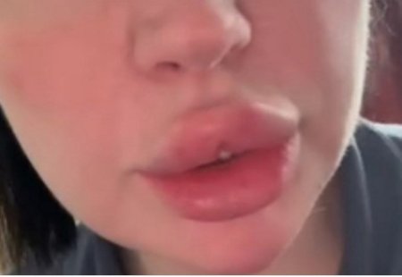 В начале марта 2026 года в сети распространились тревожные кадры, на которых поклонники заметили серьёзные проблемы с кожей лица бывшей участницы телепроекта «Дом-2» Александры Черно.