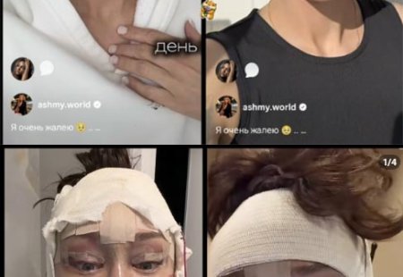 12 марта 2026 года Алёна Ашмарина, мама нескольких детей, откровенно заявила, что допустила просчёт в ходе недавней операции по подтяжке лица.