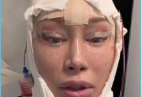 Подобно Ксении Задойновой, которая также решилась на пластическую операцию к весне, Алена Ашмарина не стала исключением.