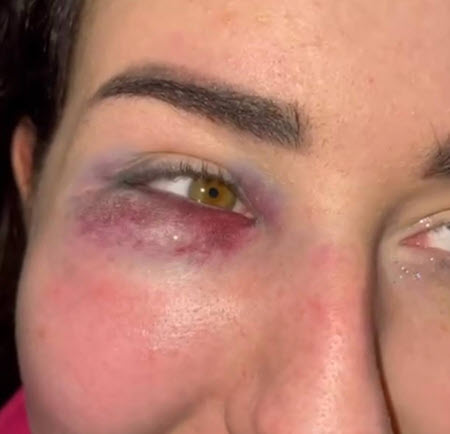 Сестру Саши Чepнo Татьяну избили в ночном клубе